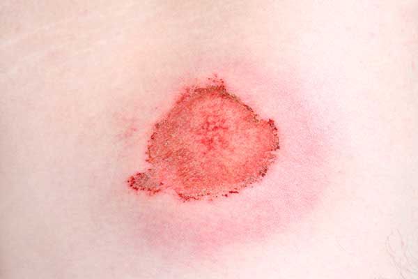 symptoms/cellulitis-skin-infection.jpg